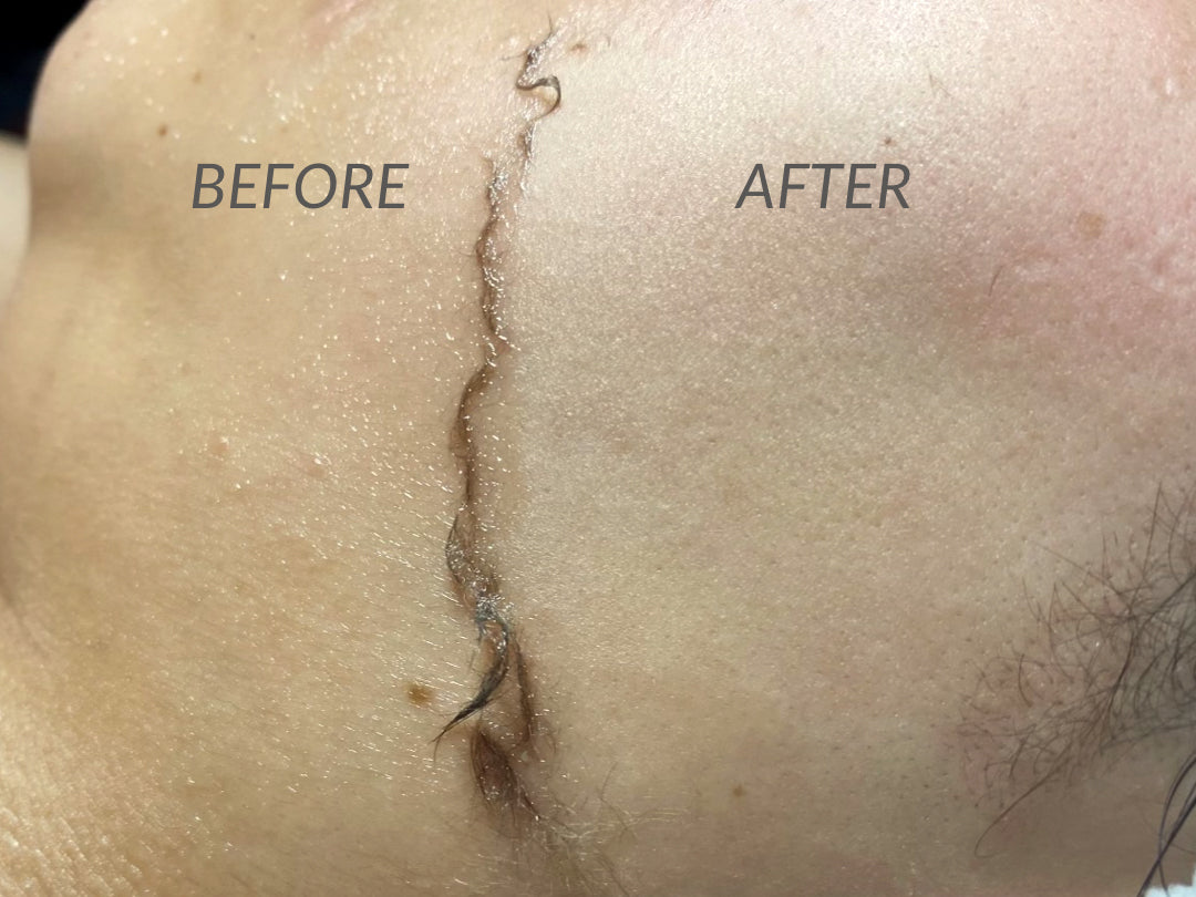 What You Need to Know Before a Dermaplaning Facial – Facial Lounge