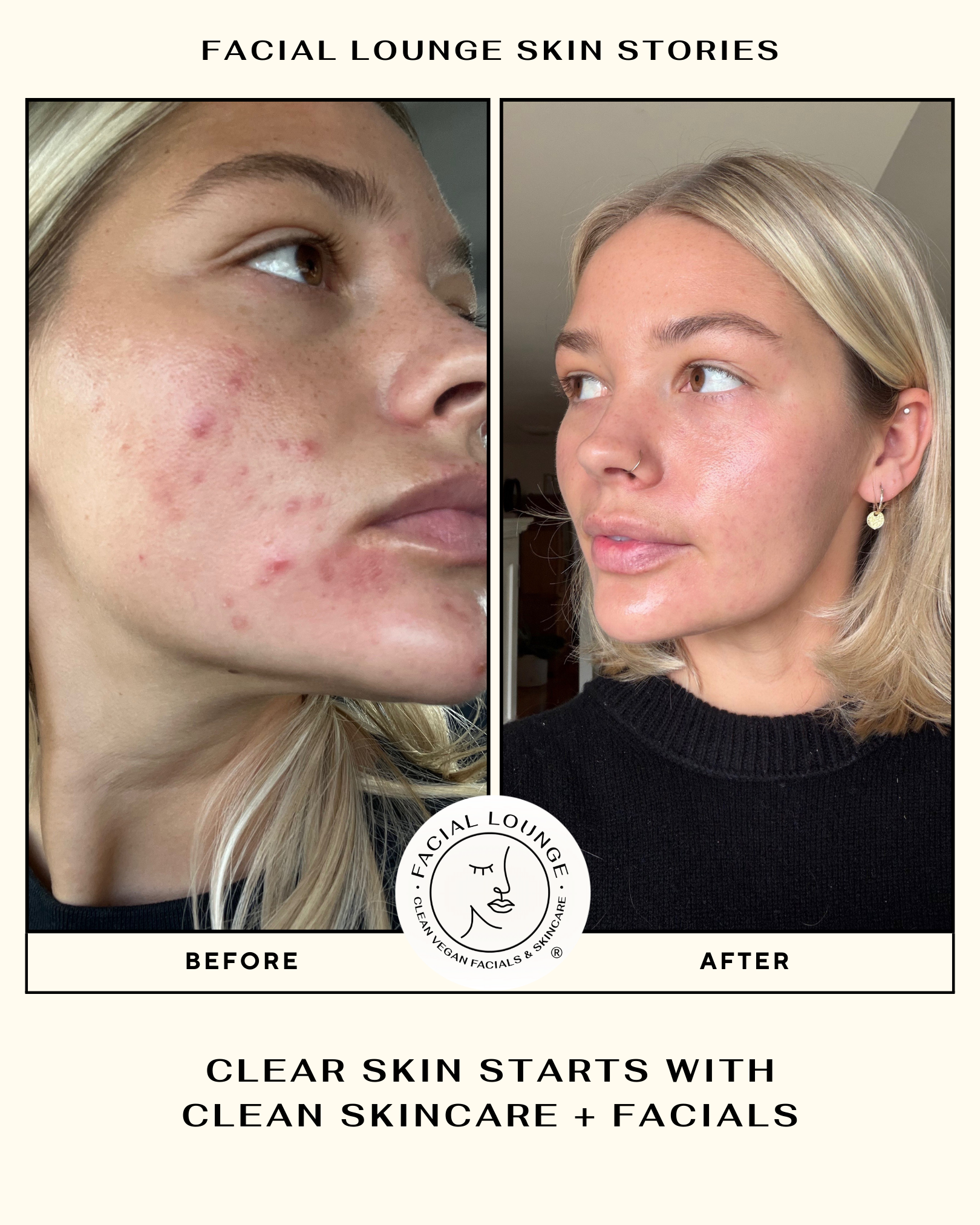 Acne Before & After: Real Results from Facial Lounge