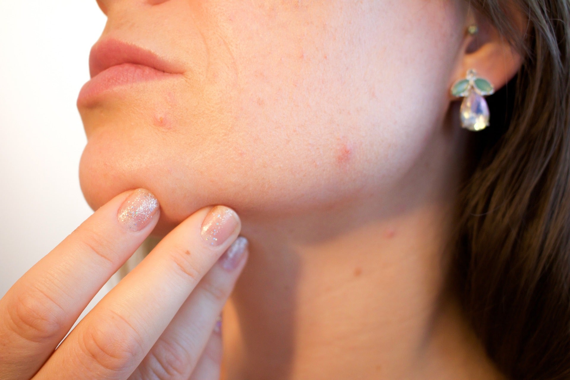 woman with acne because of toxic ingredients in skincare she's using