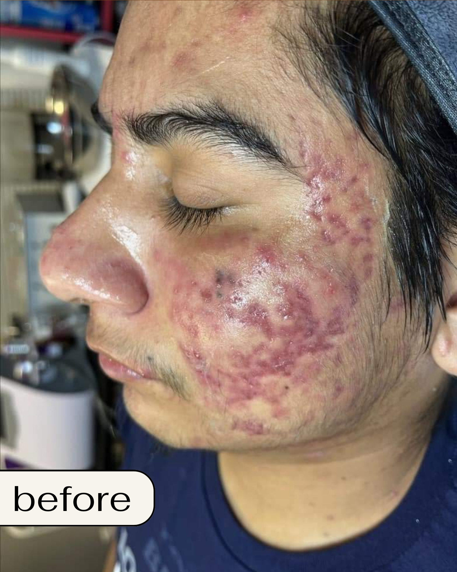 Chemical Peel in Orange County: Chemical peel Orange County, Best chemical peel OC, Chemical peel near me OC, Professional chemical peel Orange County, Gentle chemical peel OC, Affordable chemical peel Orange County, Best facial peel OC, Anti-aging chemical peel Orange County, Chemical peel for acne OC, Deep chemical peel Orange County, Chemical peel cost OC, Organic chemical peel Orange County, Sensitive skin chemical peel OC, Chemical peel for dark spots Orange County, Chemical peel for wrinkles OC, TCA peel Orange County, Orange County peel spa, Skin rejuvenation peel OC, Brightening chemical peel OC, Glow peel Orange County.  Best Spa in Orange County: Best spa in Orange County, Luxury spa Orange County, Relaxing spa OC, Spa day in Orange County, Full-service spa OC, Facial spa Orange County, Organic spa Orange County, Award-winning spa OC, Top rated spa Orange County, Affordable spa OC, Day spa Orange County, Wellness spa OC, Rejuvenating spa OC, Anti-aging spa Orange County, Spa for acne treatment OC, Natural skincare spa Orange County, Couples spa Orange County, Med spa Orange County, Skincare spa OC, Personalized spa treatments OC.  BioRePeel in Orange County: BioRePeel Orange County, BioRePeel treatment OC, BioRePeel facial Orange County, BioRePeel peel OC, Where to get BioRePeel OC, BioRePeel specialist Orange County, Best BioRePeel treatment OC, BioRePeel for sensitive skin Orange County, Anti-aging BioRePeel OC, BioRePeel for acne Orange County.