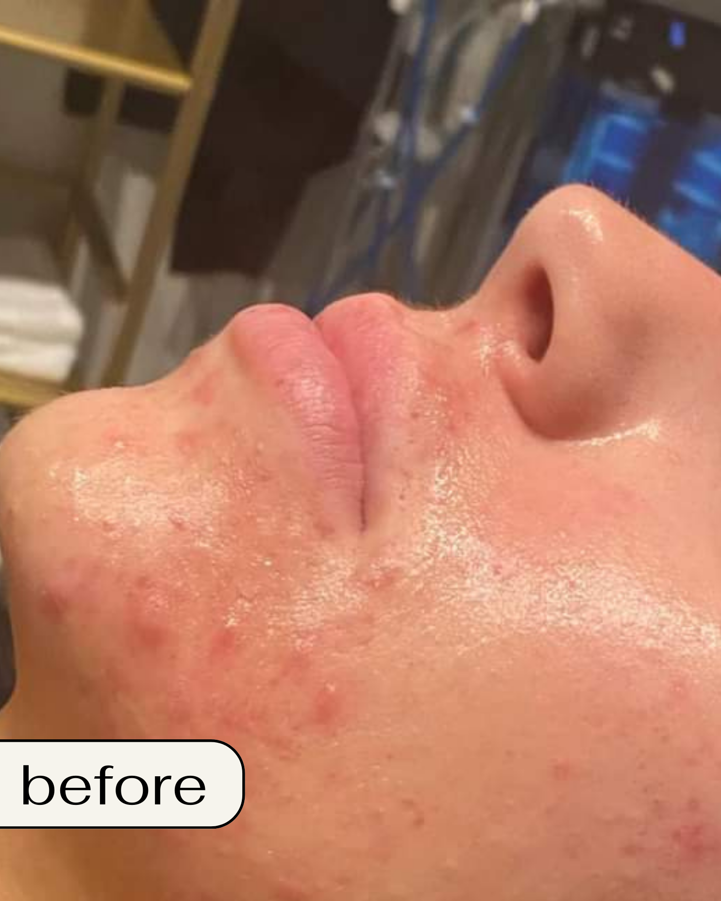 Chemical Peel in Orange County: Chemical peel Orange County, Best chemical peel OC, Chemical peel near me OC, Professional chemical peel Orange County, Gentle chemical peel OC, Affordable chemical peel Orange County, Best facial peel OC, Anti-aging chemical peel Orange County, Chemical peel for acne OC, Deep chemical peel Orange County, Chemical peel cost OC, Organic chemical peel Orange County, Sensitive skin chemical peel OC, Chemical peel for dark spots Orange County, Chemical peel for wrinkles OC, TCA peel Orange County, Orange County peel spa, Skin rejuvenation peel OC, Brightening chemical peel OC, Glow peel Orange County.  Best Spa in Orange County: Best spa in Orange County, Luxury spa Orange County, Relaxing spa OC, Spa day in Orange County, Full-service spa OC, Facial spa Orange County, Organic spa Orange County, Award-winning spa OC, Top rated spa Orange County, Affordable spa OC, Day spa Orange County, Wellness spa OC, Rejuvenating spa OC, Anti-aging spa Orange County, Spa for acne treatment OC, Natural skincare spa Orange County, Couples spa Orange County, Med spa Orange County, Skincare spa OC, Personalized spa treatments OC.  BioRePeel in Orange County: BioRePeel Orange County, BioRePeel treatment OC, BioRePeel facial Orange County, BioRePeel peel OC, Where to get BioRePeel OC, BioRePeel specialist Orange County, Best BioRePeel treatment OC, BioRePeel for sensitive skin Orange County, Anti-aging BioRePeel OC, BioRePeel for acne Orange County.