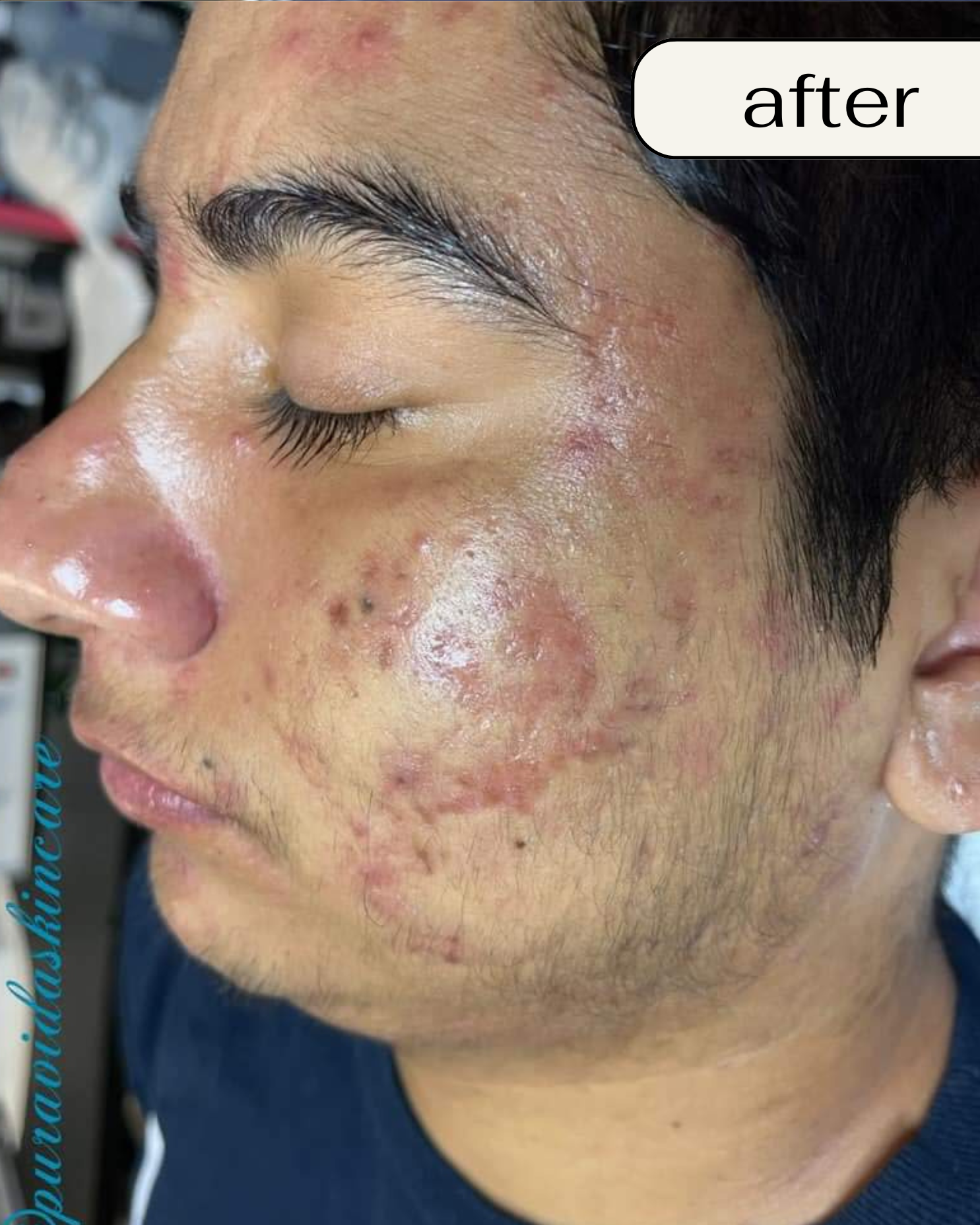 Chemical Peel in Orange County: Chemical peel Orange County, Best chemical peel OC, Chemical peel near me OC, Professional chemical peel Orange County, Gentle chemical peel OC, Affordable chemical peel Orange County, Best facial peel OC, Anti-aging chemical peel Orange County, Chemical peel for acne OC, Deep chemical peel Orange County, Chemical peel cost OC, Organic chemical peel Orange County, Sensitive skin chemical peel OC, Chemical peel for dark spots Orange County, Chemical peel for wrinkles OC, TCA peel Orange County, Orange County peel spa, Skin rejuvenation peel OC, Brightening chemical peel OC, Glow peel Orange County.  Best Spa in Orange County: Best spa in Orange County, Luxury spa Orange County, Relaxing spa OC, Spa day in Orange County, Full-service spa OC, Facial spa Orange County, Organic spa Orange County, Award-winning spa OC, Top rated spa Orange County, Affordable spa OC, Day spa Orange County, Wellness spa OC, Rejuvenating spa OC, Anti-aging spa Orange County, Spa for acne treatment OC, Natural skincare spa Orange County, Couples spa Orange County, Med spa Orange County, Skincare spa OC, Personalized spa treatments OC.  BioRePeel in Orange County: BioRePeel Orange County, BioRePeel treatment OC, BioRePeel facial Orange County, BioRePeel peel OC, Where to get BioRePeel OC, BioRePeel specialist Orange County, Best BioRePeel treatment OC, BioRePeel for sensitive skin Orange County, Anti-aging BioRePeel OC, BioRePeel for acne Orange County.