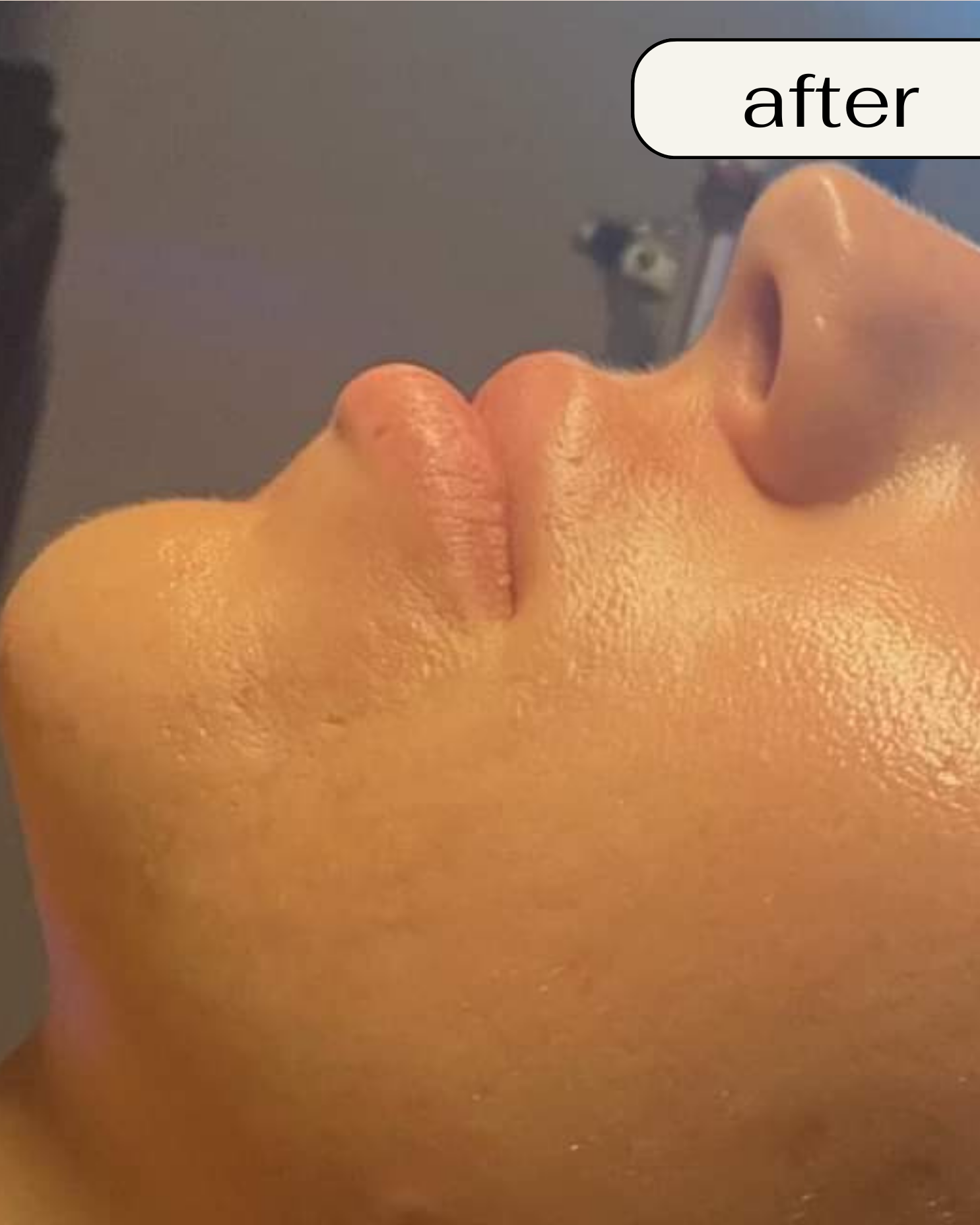 Chemical Peel in Orange County: Chemical peel Orange County, Best chemical peel OC, Chemical peel near me OC, Professional chemical peel Orange County, Gentle chemical peel OC, Affordable chemical peel Orange County, Best facial peel OC, Anti-aging chemical peel Orange County, Chemical peel for acne OC, Deep chemical peel Orange County, Chemical peel cost OC, Organic chemical peel Orange County, Sensitive skin chemical peel OC, Chemical peel for dark spots Orange County, Chemical peel for wrinkles OC, TCA peel Orange County, Orange County peel spa, Skin rejuvenation peel OC, Brightening chemical peel OC, Glow peel Orange County.  Best Spa in Orange County: Best spa in Orange County, Luxury spa Orange County, Relaxing spa OC, Spa day in Orange County, Full-service spa OC, Facial spa Orange County, Organic spa Orange County, Award-winning spa OC, Top rated spa Orange County, Affordable spa OC, Day spa Orange County, Wellness spa OC, Rejuvenating spa OC, Anti-aging spa Orange County, Spa for acne treatment OC, Natural skincare spa Orange County, Couples spa Orange County, Med spa Orange County, Skincare spa OC, Personalized spa treatments OC.  BioRePeel in Orange County: BioRePeel Orange County, BioRePeel treatment OC, BioRePeel facial Orange County, BioRePeel peel OC, Where to get BioRePeel OC, BioRePeel specialist Orange County, Best BioRePeel treatment OC, BioRePeel for sensitive skin Orange County, Anti-aging BioRePeel OC, BioRePeel for acne Orange County.