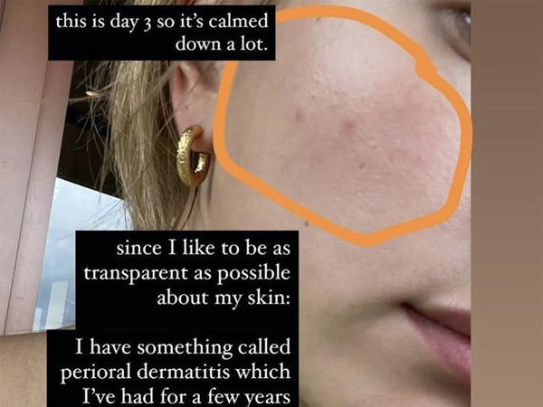 Perioral Dermatitis Kit